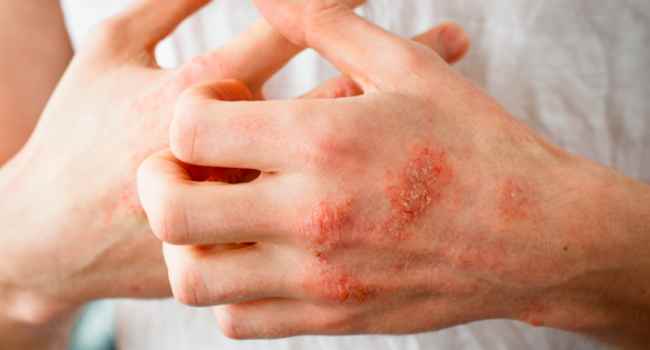 Экзема мошонки от чего бывает как лечить в домашних условиях Экзема мошонки от чего бывает как лечить в домашних условиях